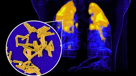 100 Millionen Euro jährlich – Die versteckten Kosten der Tuberkulose bei ausländischen Patienten in Deutschland